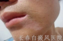 夏季白癜风的预防方法 夏季白癜风的预防方法