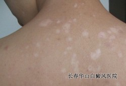 早期白癜风怎样治疗 早期白癜风怎样治疗
