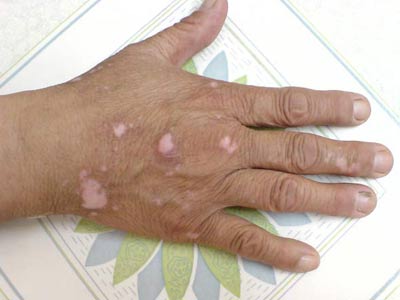 白癜风引起的原因都有哪些